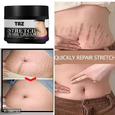 Stretch Mark Removing Cream