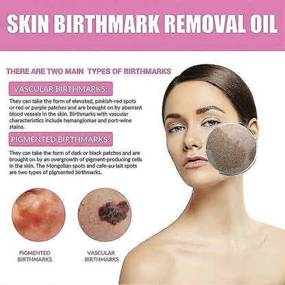 Birthmark Removal Oil 10ML (Pack of 2)